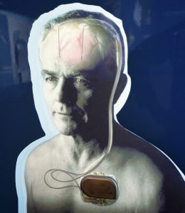 "Hirnschrittmacher" mit zwei Elektroden und dem Impulsgeber in der Brust